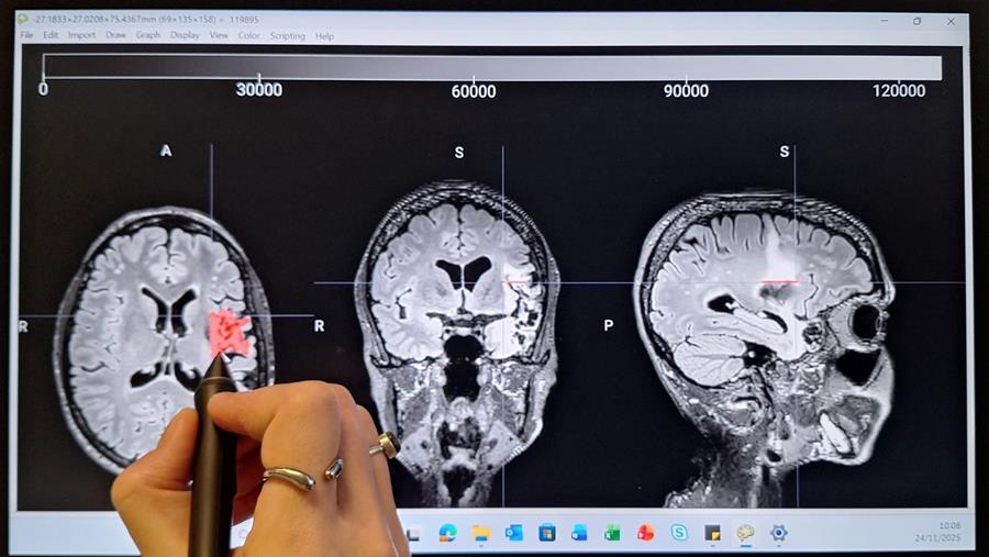 Cognitieve stoornissen na beroerte vragen om zorg op maat
