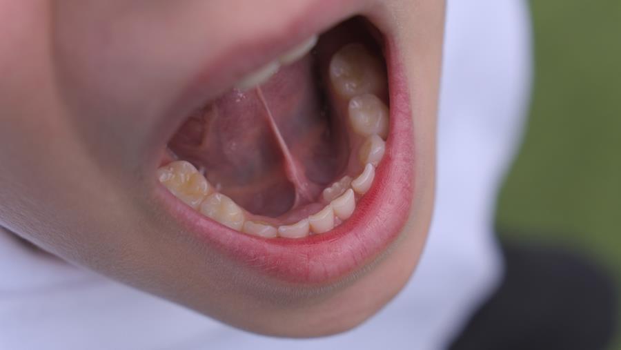 KCE zal klinische praktijkrichtlijn voor frenotomie ontwikkelen